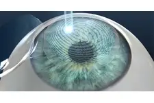 Göz Nakli Nedir ve Nasıl Yapılır?
