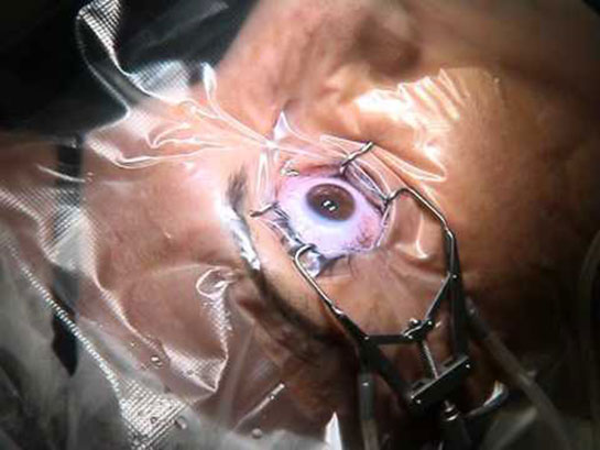 Göz Çizdirme Ameliyatı
